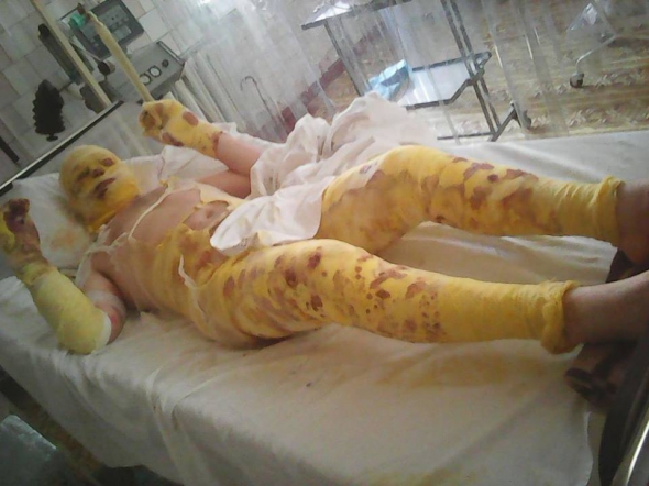 Олександр Бегерський з важкими опіками у перші дні після поранення