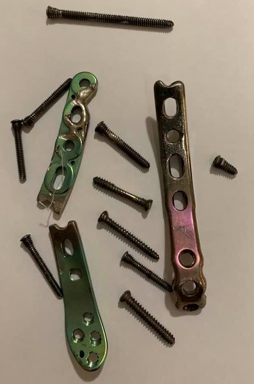 «Як виявилося, українські кістки здатні гнути і ламати ізраїльський титан…» - написав Дмитро Ярош, проілюструвавши це світлиною із операційної.